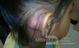 Acute mastoiditis
