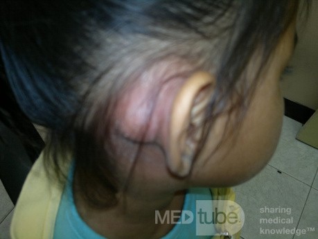 Acute mastoiditis