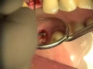 Tooth in one hour