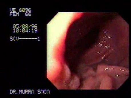 Gastric Cancer Type I -Endoskopy