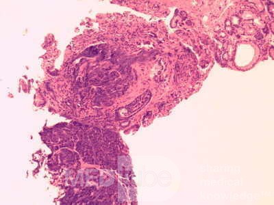 Heterotopic Pancreas with large Central Hole (4 of 6)