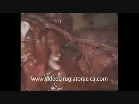 Uniportal VATS Anatomic Lingulectomy