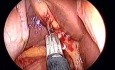 Totally transumbilical cholecystectomy