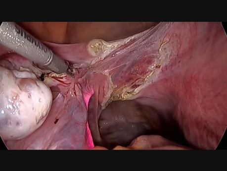 TLH with Ureter Stenting in Nellore