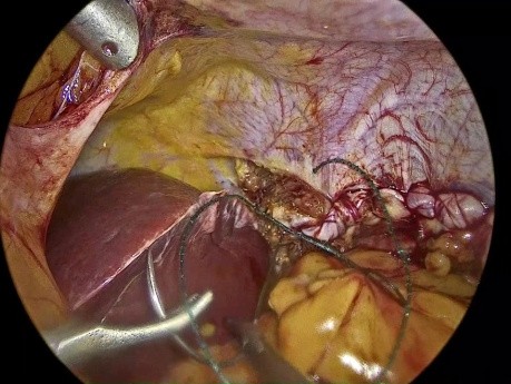 Laparoscopic Mesh Repair of Diaphragm Eventration