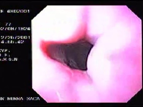 Hemorrhage due status post rubber band ligation of esophageal varices (6 of 25)