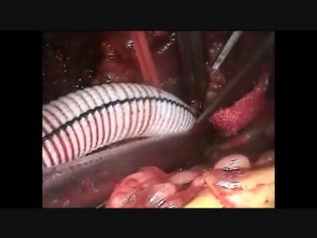 ECMO Cannulation Technique