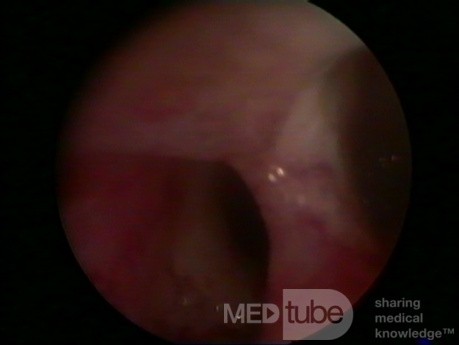 SEPTUM UTERI BY HYSTEROSCOPE