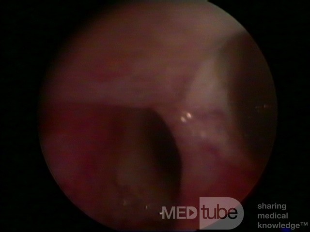 SEPTUM UTERI BY HYSTEROSCOPE