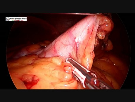 Sleeve Gastrectomy with Hernia Repair