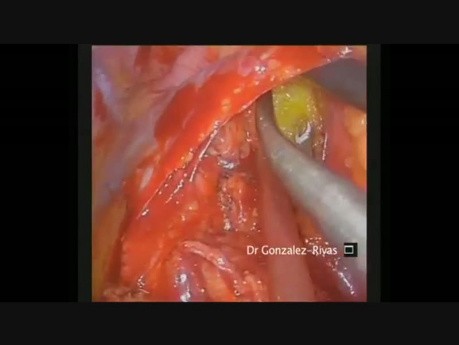 Paratracheal Lymph Node Dissection by Single Port VATS