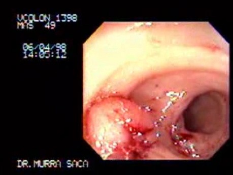 Cecum stalk polyp inside of the appendiceal orifice (2 of 2)