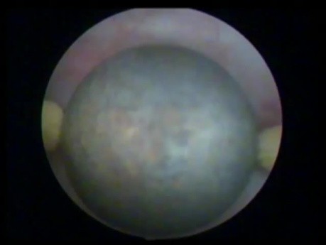 Transurethral Prostatectomy