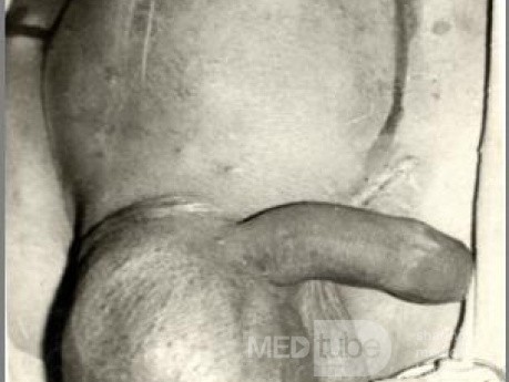 Abdominoscrotal Hydrocele