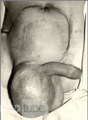 Abdominoscrotal Hydrocele