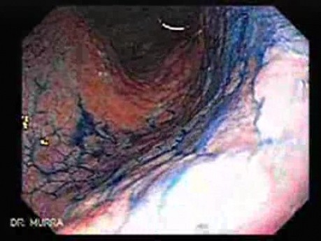 Chronic Gastritis (4 of 8)