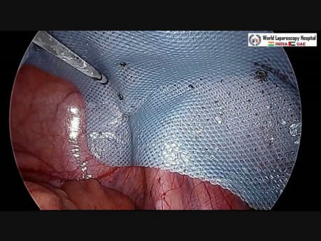 Intraperitoneal Onlay Mesh Repair of Inguinal Hernia
