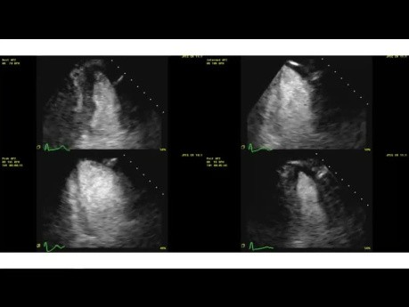 Stress Echocardiography Principles of Ischemia Evaluation and Clinical Cases