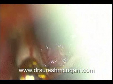 ACOMA+ICA Aneurysm - Anterior Communicating Artery & Internal Carotid Artery Aneurysm