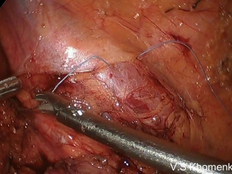 Correction of an Extended Stricture of the Right Ureter using un appendicular flap