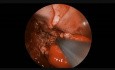 Endoscopic Resection of a Juvenile Nasopharyngeal Angiofibroma