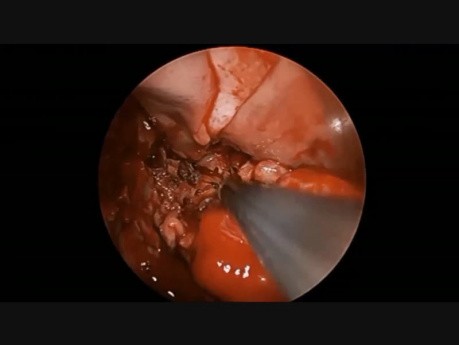 Endoscopic Resection of a Juvenile Nasopharyngeal Angiofibroma