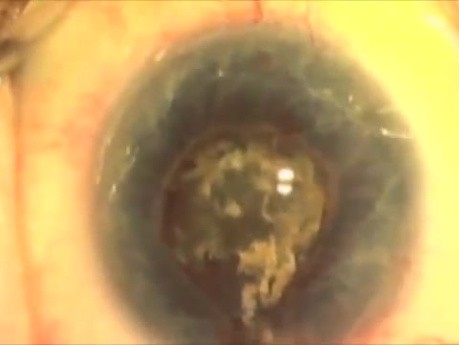 Plasma ablation capsulotomy