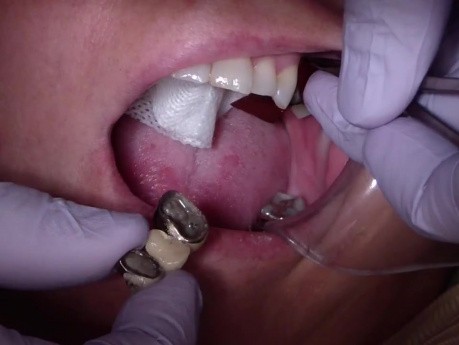 Bridge Insert: Check Bridge Pontic Site To Prevent Binding