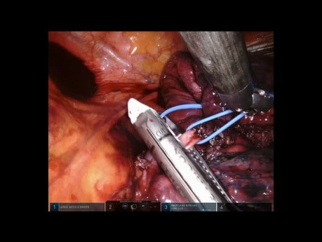 Small Lung Tumor at S3 (Left Upper Lobe Anterior Segment)