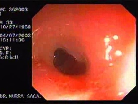 Endoscopic View of Amebiasis Colitis (5 of 7)