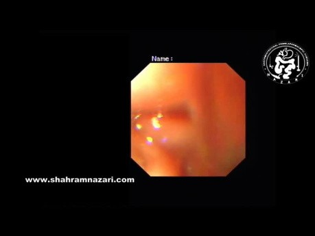 Esophageal Diverticulum in a Case of Achalasia