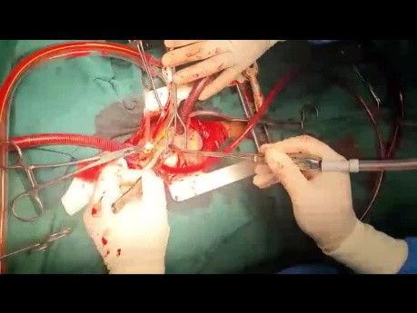 Parachute Mitral Valve Replacement in an Adult  from LA Access