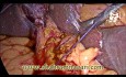 Laparoscopic Cholecystectomy / LCBD Exploration and Choledochoduodenostomy