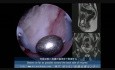 Roller Ball Hysteroscopic Technique for Fundal Submucous Myoma