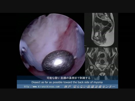 Roller Ball Hysteroscopic Technique for Fundal Submucous Myoma
