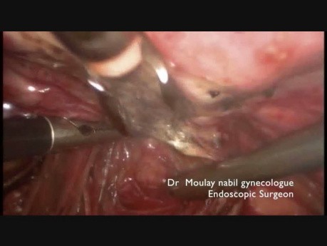 Utero Sacral Endometriosic Nodule Resection