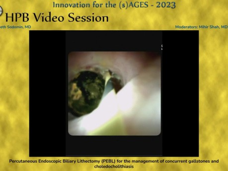 Percutaneous Endoscopic Biliary Lithectomy (Pebl) for the Management of Concurrent Gallstones