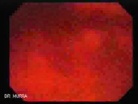 Adenocarcinoma of the Antrum (3 of 5)