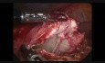 Laparoscopic Hydatid Cyst Surgery