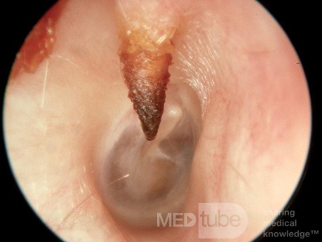 Unusual Bony Spur External Ear Canal