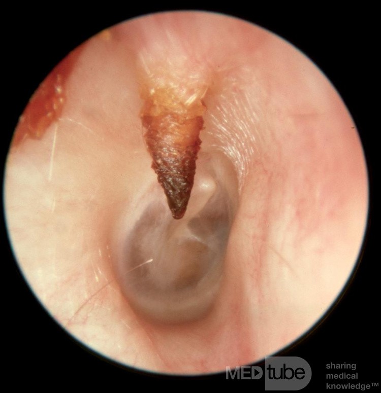 Unusual Bony Spur External Ear Canal