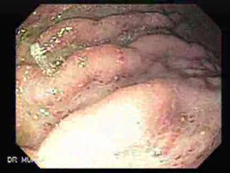 Ovarian Carcinoma with Gastric and Duodenal Metastases - Assessment of the Lesions 