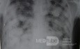 Chest X-Ray