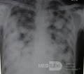Chest X-Ray