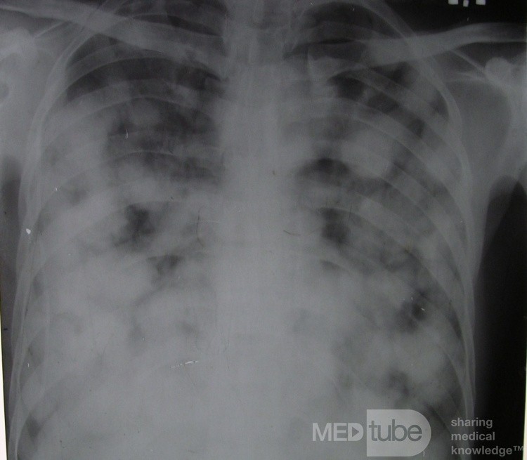 Chest X-Ray