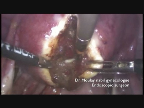 Laparoscopic Myomectomy. Medial Approach for Vascular Control.