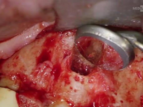 Microsurgical Management Of Via Falsa In Obliterated Canal