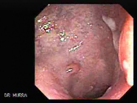 Rectal Discharge with Mucoid Secretion