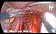 Laparoscopic Heller Myotomy: Stretching and Tearing Technique