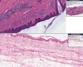 Lymphocytic Infiltrate (Possible Tick Bite)